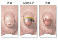 包皮過長手術后圖片