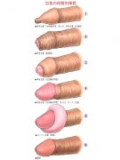 包皮過長、包莖的圖片