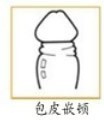 嵌頓性包莖圖片