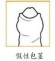 假性包莖圖片