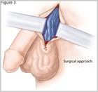 精索靜脈曲張圖片