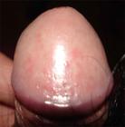 急性淺表性龜頭炎