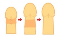 陰莖延長術多少錢